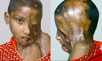 Bố tạt axit đánh ghen với mẹ, bé gái 4 tuổi trở thành nạn nhân đáng thương nhất với khuôn mặt hoàn toàn biến dạng