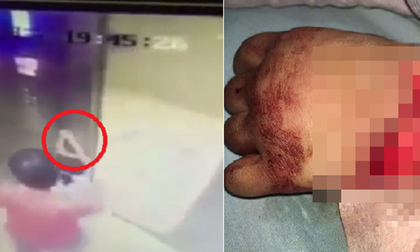 Bé gái bị thương nghiêm trọng khi đi thang máy bởi sai lầm cha mẹ hay gặp phải