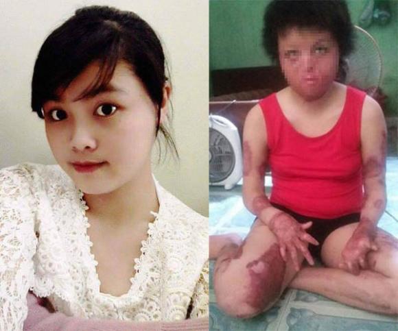 Thiếu phụ xinh đẹp bị chồng tẩm xăng đốt giờ ra sao? - 2