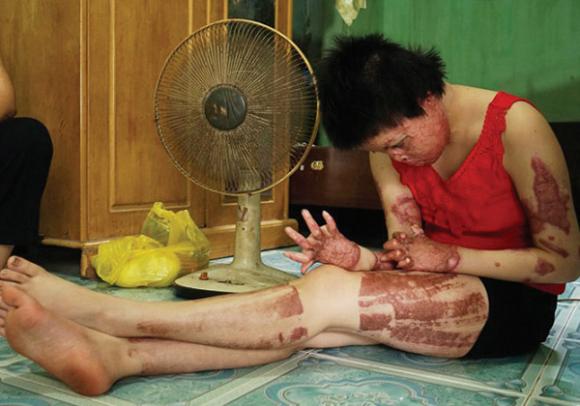 Thiếu phụ xinh đẹp bị chồng tẩm xăng đốt giờ ra sao? - 1