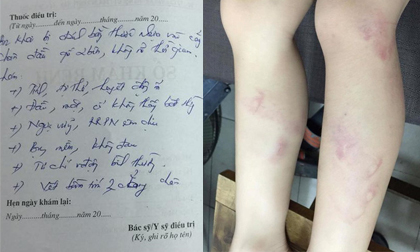 Hà Nội: Vào lớp muộn, học sinh tiểu học bị cô giáo đánh tím tái hai chân đến khi gãy thước?