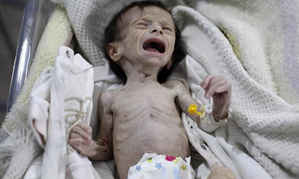 Em bé Syria với thân hình chỉ còn da bọc xương giữa bom đạn chiến tranh khiến cả thế giới xót xa