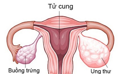 10 dấu hiệu cảnh báo ung thư buồng trứng sớm nhất, chị em cần lưu ý