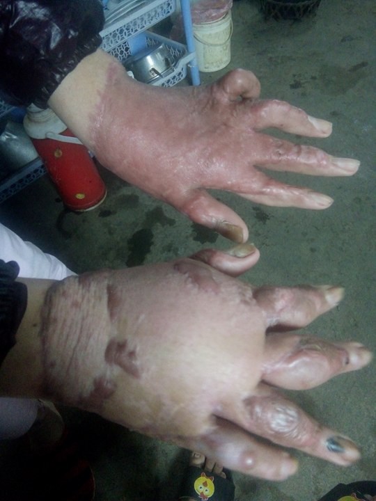 
Bàn tay chị Trang đã được phẫu thuật tay nhưng vẫn khó khăn trong việc cầm, nắm (ảnh nhân vật cung cấp)
