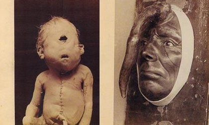 8 hiện tượng 'quái dị' nhất thế giới được lưu giữ trong lịch sử khiến giới y học 'đau đầu'