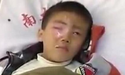 Bé trai mù mắt vì nghịch ngợm gói hút ẩm, đồ vật này tuyệt đối để xa tầm tay trẻ