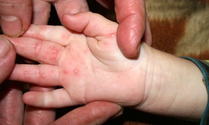 Bé gái 2 tuổi tử vong sau 3 ngày mắc bệnh tay chân miệng