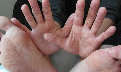 6 ca tử vong vì bệnh tay chân miệng: Chủng virus EV71 nguy hiểm thế nào?