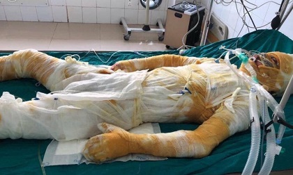 Giúp xưởng mộc chữa cháy, nam thanh niên 25 tuổi bị bỏng lột da toàn thân, tính mạng nguy kịch