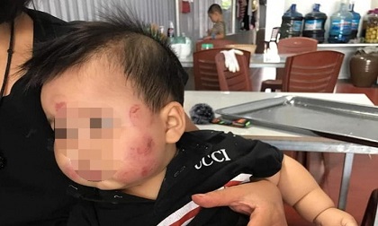 Làm rõ vụ bé 10 tháng tuổi tím đùi, mặt nhiều vết thương sau khi từ trường mầm non về