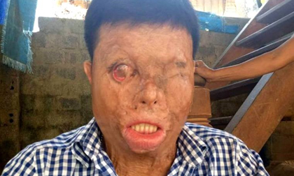 Thanh Hóa: Phận đời khốn khổ của chàng thanh niên bị tạt axit nhầm