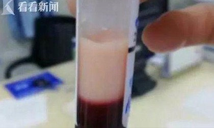 Máu của người đàn ông 33 tuổi biến thành sữa, chỉ vì thích ăn loại thực phẩm này