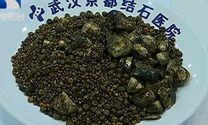 Người phụ nữ có 7.750 viên sỏi mật vì hai thói quen tệ hại không ít người cũng mắc