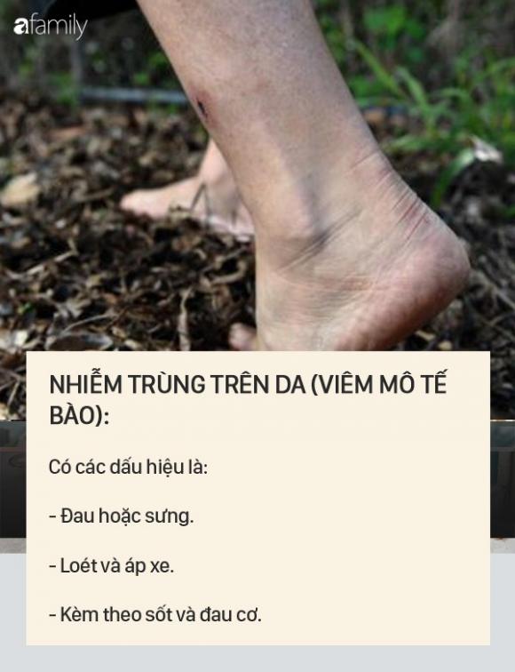 Dấu hiệu bệnh whitmore - căn bệnh do vi khuẩn ăn mòn cơ thể con người, có thể gây tử vong trong vài ngày - 3