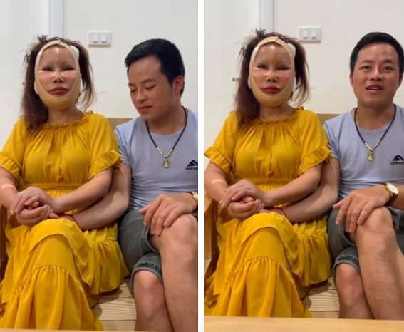 Diện mạo mới của cô dâu 62 tuổi ở Cao Bằng sau 3 ngày khiến dân mạng khiếp vía vì hậu phẫu căng da mặt - Ảnh 1.