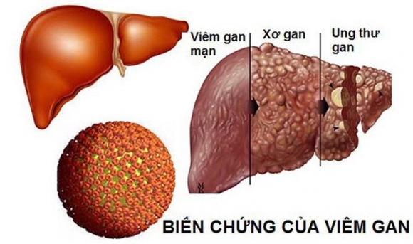 5 kiểu người dễ bị ung thư gan nhất, xem bạn có trong số đó không