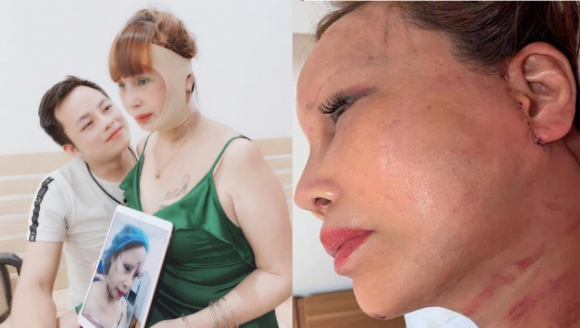 Sau một tháng phẫu thuật, gương mặt của cô Thu Sao vẫn sưng phù, phần tai chằng chịt vết khâu