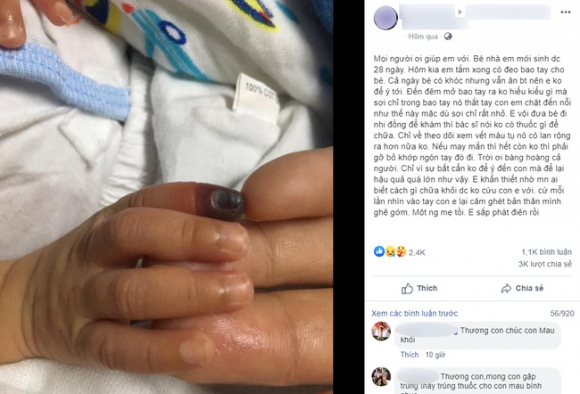 Bé sơ sinh có nguy cơ hoại tử đốt ngón tay do mẹ đeo bao tay cho con cả ngày không tháo