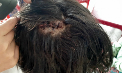 Nữ sinh bị gã côn đồ đánh dã man sau tai nạn: Nhập viện trong tình trạng hoảng loạn, khâu 10 mũi trên đầu