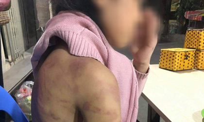 Vụ bạo hành dã man bé gái 12 tuổi: Bị 'người tình' của mẹ xâm hại tình dục nhiều lần?