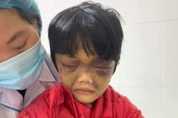 Điều tra vụ bé gái 6 tuổi bị mẹ đẻ đánh tới nhập viện ở Hải Dương