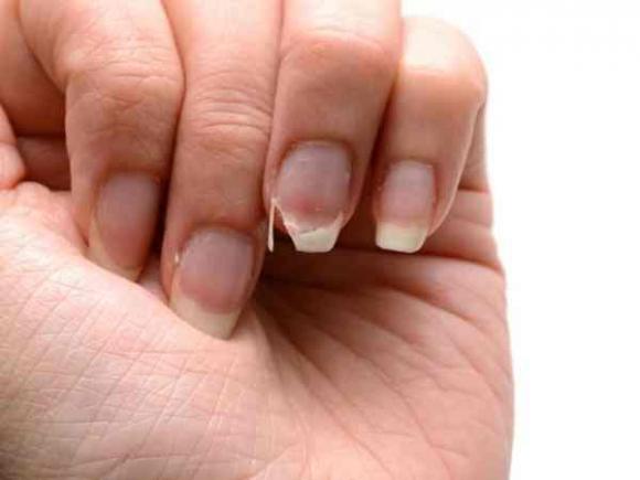 5 dấu hiệu tố cáo cơ thể đang bị thiếu hụt canxi nghiêm trọng, xương càng ngày càng giòn, dễ gãy