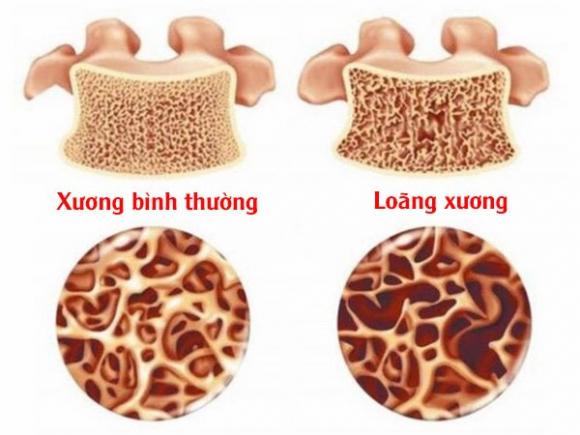 5 dấu hiệu tố cáo cơ thể đang bị thiếu hụt canxi nghiêm trọng, xương càng ngày càng giòn, dễ gãy