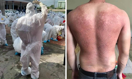 Hình ảnh bác sĩ nơi tâm dịch Bắc Giang khiến nhiều người xót xa: Phía sau lớp áo bảo hộ là tấm lưng cháy nắng phồng rộp