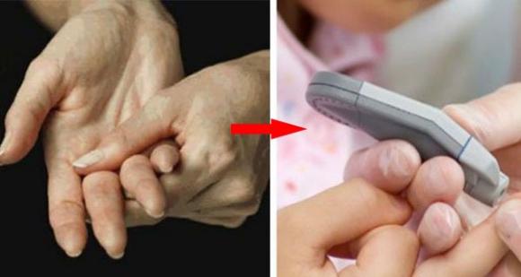 3 dấu hiệu đường huyết cao dễ thấy nhất ở tay chân: Dành 5 giây kiểm tra có thể tự cứu chính mình