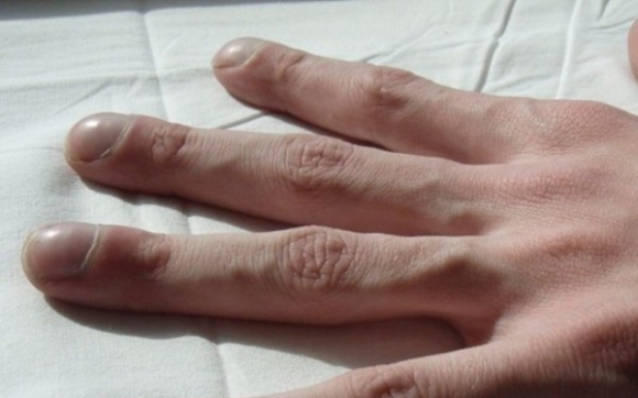 4 triệu chứng trên ngón tay cho thấy chất độc trong cơ thể đang bùng phát: Đi khám gan, phổi ngay kẻo muộn