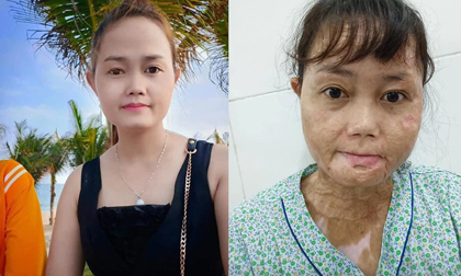 Người phụ nữ bị chồng thiêu sống bỏng đến 92%: 'Khi các con đã đi ngủ, tôi khóc ướt gối'