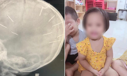 Vụ bé 3 tuổi nghi bị bắn 9 đinh vào đầu: Đội điều tra trọng án tiếp nhận hồ sơ điều tra