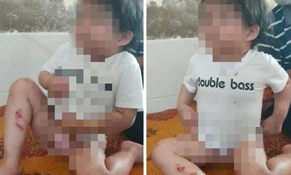 Vụ bé 4 tuổi bị bạo hành: Công an tạm giữ dì ruột để điều tra