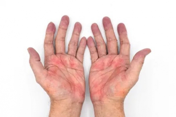 Bàn tay xuất hiện 5 dấu hiệu này chứng tỏ bệnh gan đã đi vào giai đoạn nặng, có 1 cũng phải đi khám