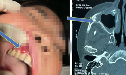 Hà Nội ghi nhận 2 ca hoại tử xương hàm tử vong: Khi nào cần kiểm tra xương hàm sau mắc Covid-19?