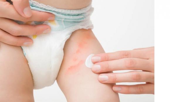 6 cách trị hăm cho trẻ. Đặc biệt, không nên bỏ qua cách số 6!