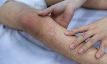 Hà Nội: Phát sinh 58 ổ dịch với hơn 1.300 ca mắc sốt xuất huyết trong tuần qua