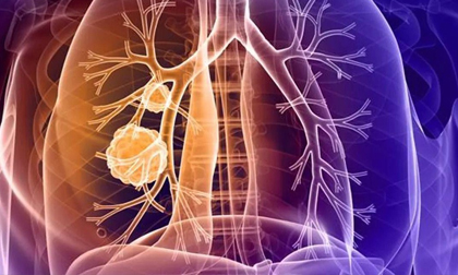 2 vị trí đau bất thường cảnh báo ung thư phổi nhưng dễ bị bỏ qua
