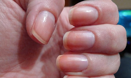 Nhìn tình trạng móng tay biết bạn đang mắc bệnh gì, cực chuẩn